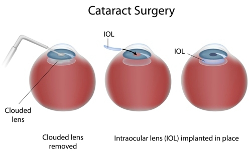 Cataract Treatment Perth