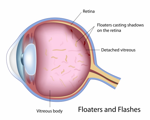 Floaters and flashes treatment Perth